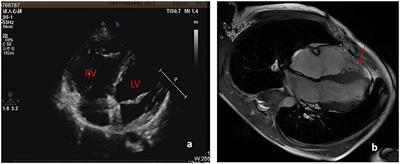 Propafenone-Induced QRS Widening in a Child With Arrhythmogenic Right Ventricular Cardiomyopathy: A Case Report and Literatures Review